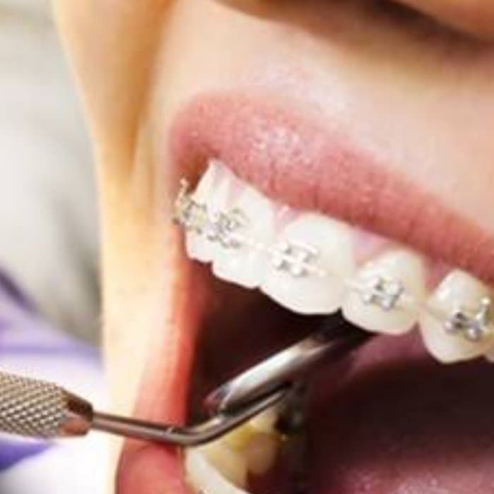 Professional teeth cleaning
